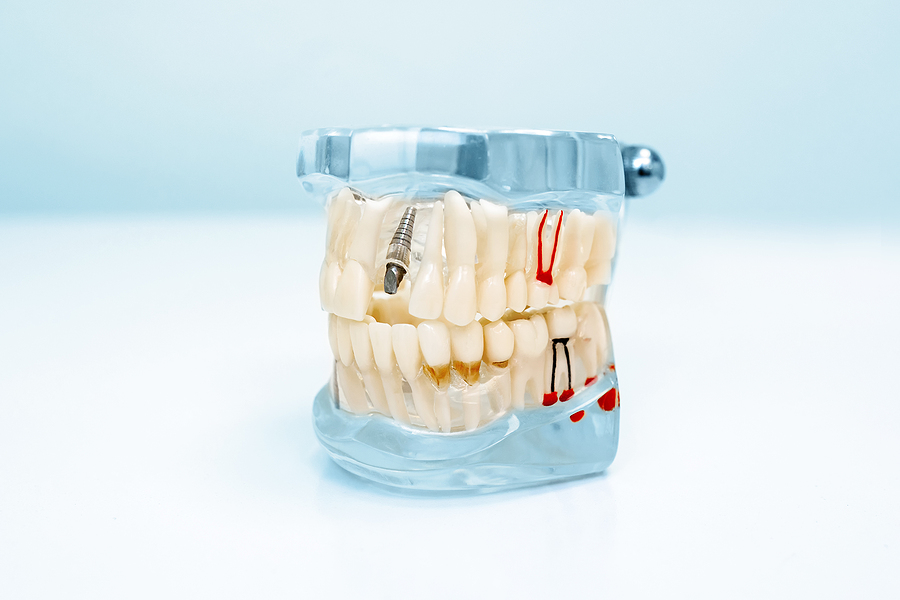 Dental Implant. Dentistry. Prosthetics. Transparent Model Of Hum
