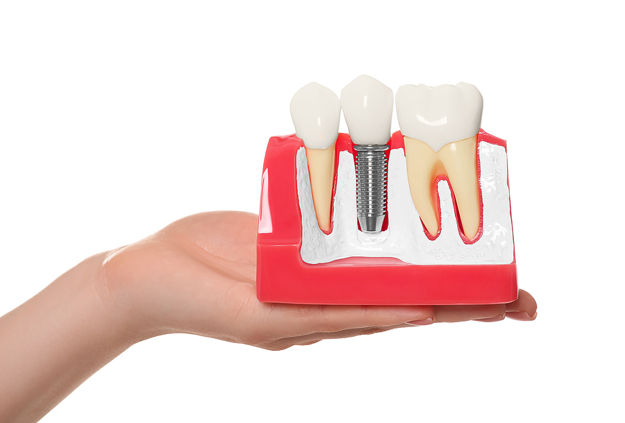 Dentist Holding Educational Model Of Dental Implant On White Bac