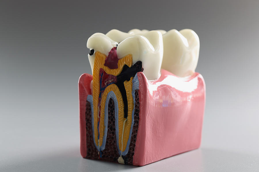 Teaching Model Of A Tooth In Cross Section On A Gray Background,
