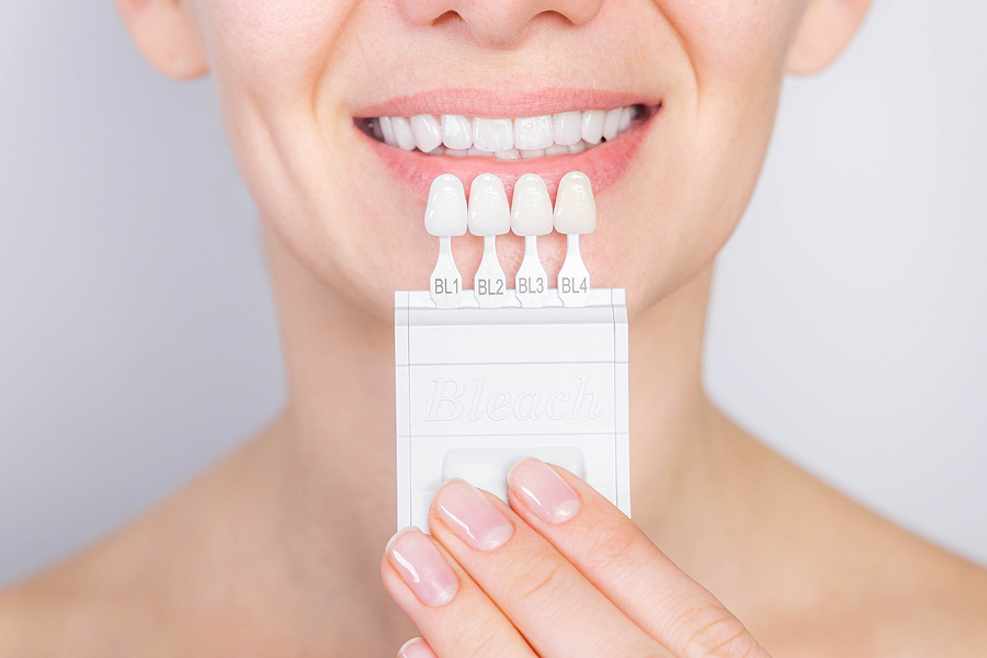 Tooth Whitening, Perfect White Teeth Close Up With Shade Guide B Veneers