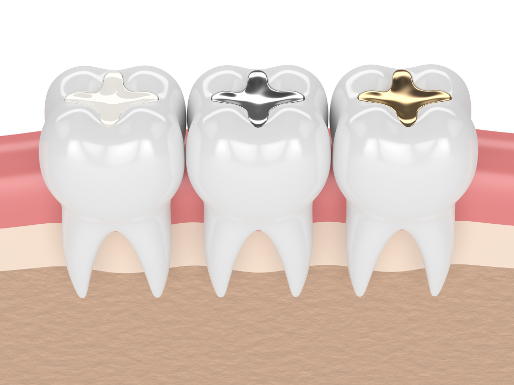 3d,Render,Of,Teeth,With,Gold,,Amalgam,And,Composite,Inlay