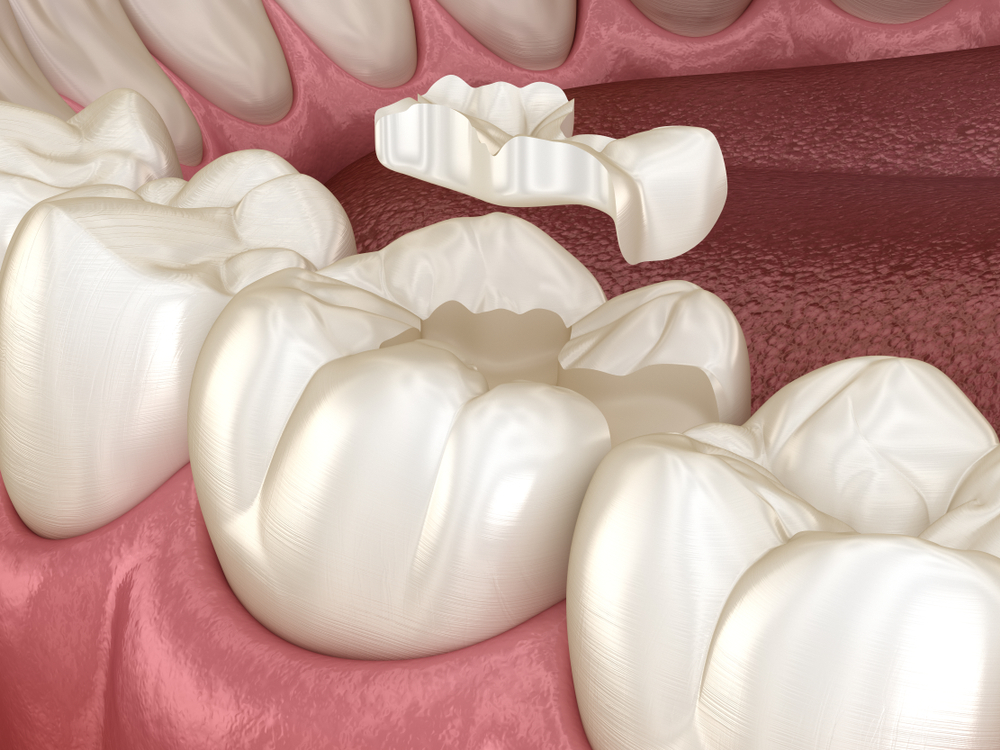 Inlay,Ceramic,Crown,Fixation,Over,Tooth.,Medically,Accurate,3d,Illustration