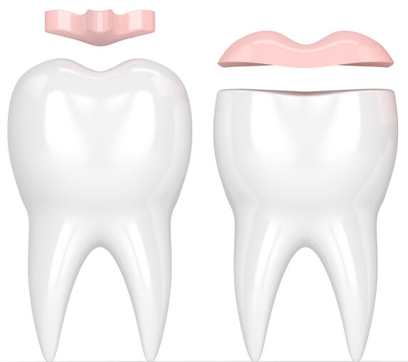 3d,Render,Of,Teeth,With,Inlay,,Onlay,And,Crown,Filling