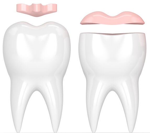 3d,Render,Of,Teeth,With,Inlay,,Onlay,And,Crown,Filling 3d,Render,Of,Teeth,With,Inlay,,Onlay,And,Crown,Filling