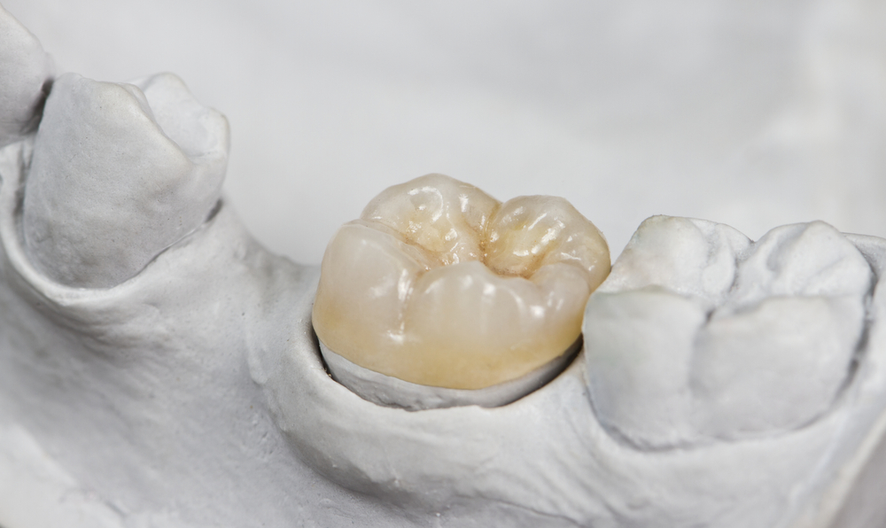 Closeup,For,Dental,Onlay,On,A,Molar,Tooth,Shown,On